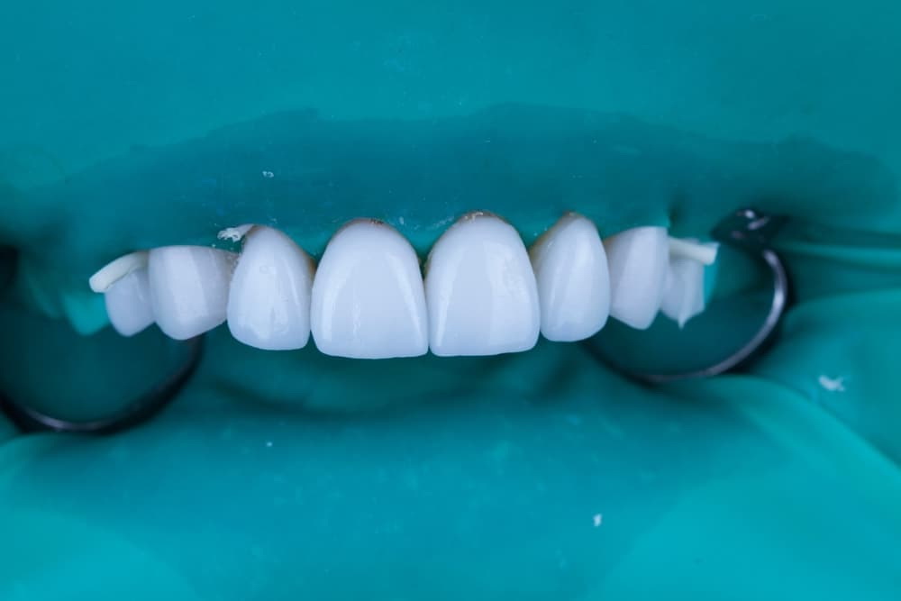 vitavladent kofferdam3